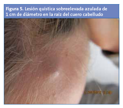 Figura 5. Lesión quística sobreelevada azulada de 1 cm de diámetro en la raíz del cuero cabelludo
