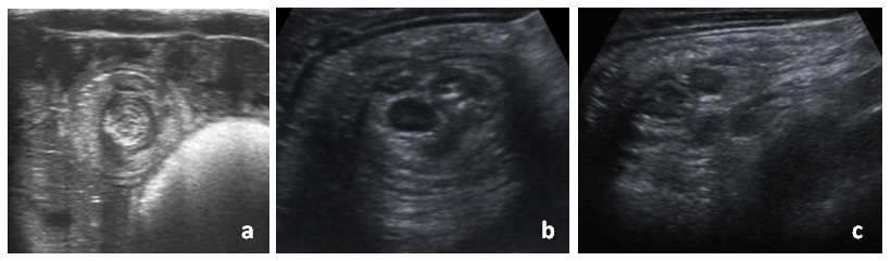 Figura 1. Imágenes ecográficas de invaginación intestinal. a) Corte sagital de una invaginación intestinal ileoileal (imagen en diana o donut); b) corte sagital de una invaginación ileocólica, con adenopatías en su interior; c) corte longitudinal de una invaginación ileocólica (imagen en pseudorriñón)