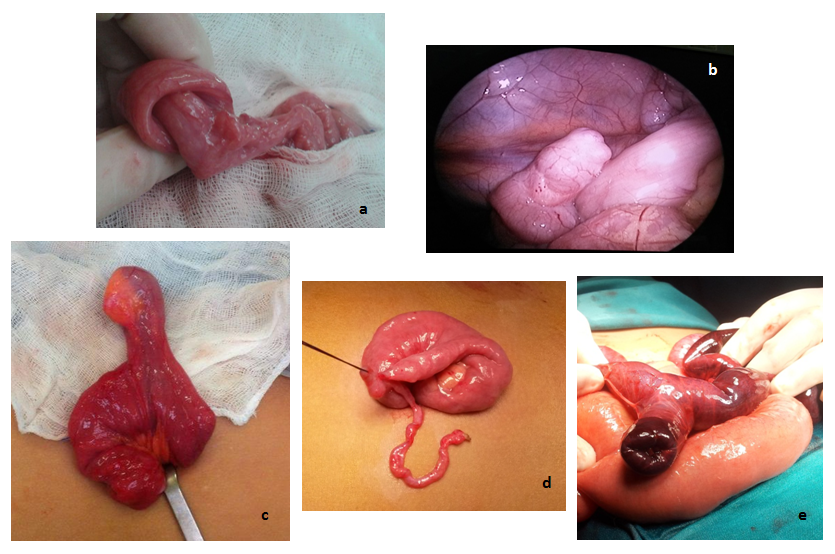 Figura 4. Imágenes quirúrgicas. a) Invaginación intestinal; b) divertículo de Meckel, hallazgo laparoscópico; c) divertículo de Meckel exteriorizado a través de incisión umbilical; d) continuación de divertículo de Meckel con conducto onfalomesentérico obliterado; e) divertículo de Meckel complicado, tras invaginación del mismo