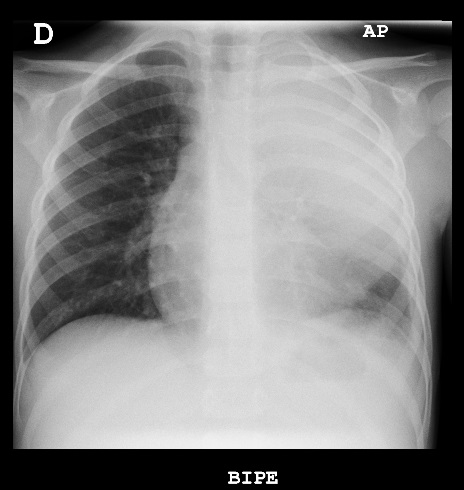 Figura 1. Consolidación de lóbulo superior izquierdo acompañado de derrame pleural que ocupa todo el hemitórax ipsilateral