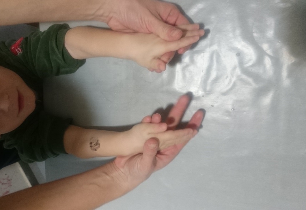 Figura 1. Máxima supinación en ambas extremidades superiores.