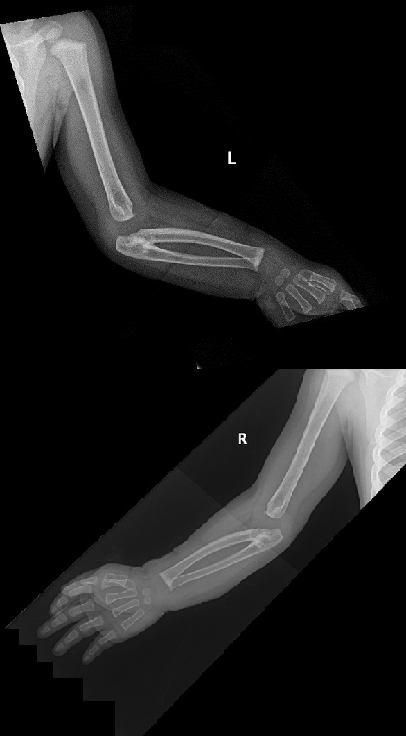 Figura 2. Radiografía de ambas extremidades: sinostosis radiocubital tipo II.