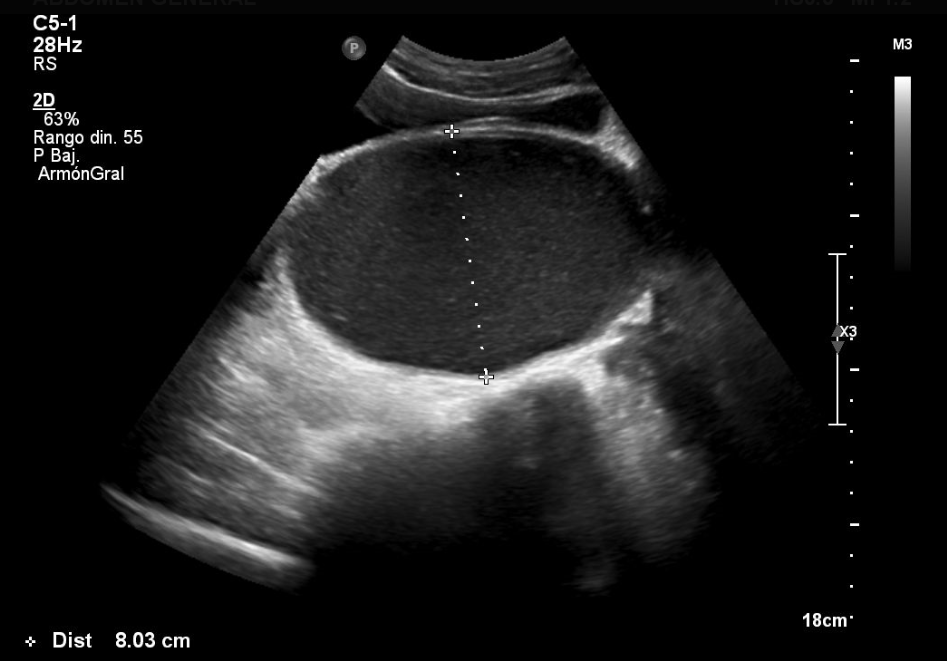 Figura 1. Hematocolpos