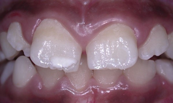 Figura 3. Amplia zona de hipomineralización en el incisivo central derecho