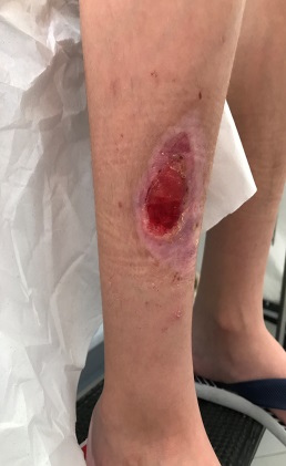 Figura 1. Lesión inicial.