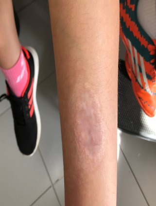 Figura 2. Lesión cicatricial.