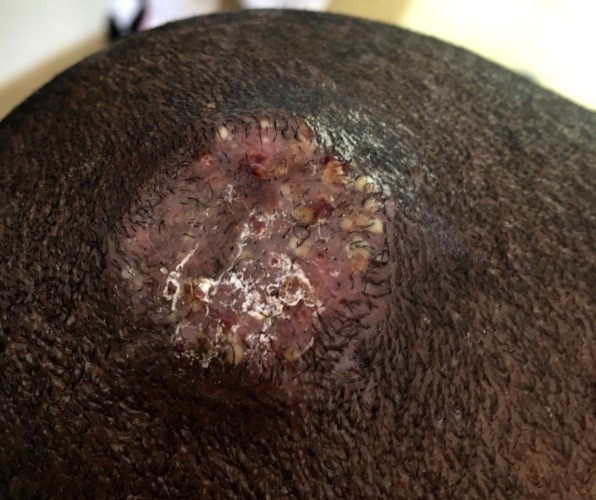 Figura 1. Placa alopécica inflamatoria con vesículas pustulosas en la zona parietotemporal derecha de 3 × 3 cm