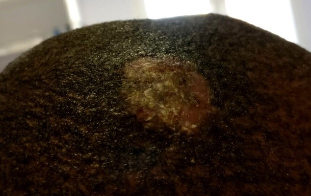 Figura 2. Aspecto a las tres semanas de tratamiento: desaparece la inflamación y se observan lesiones costrosas y algunos folículos pilosos