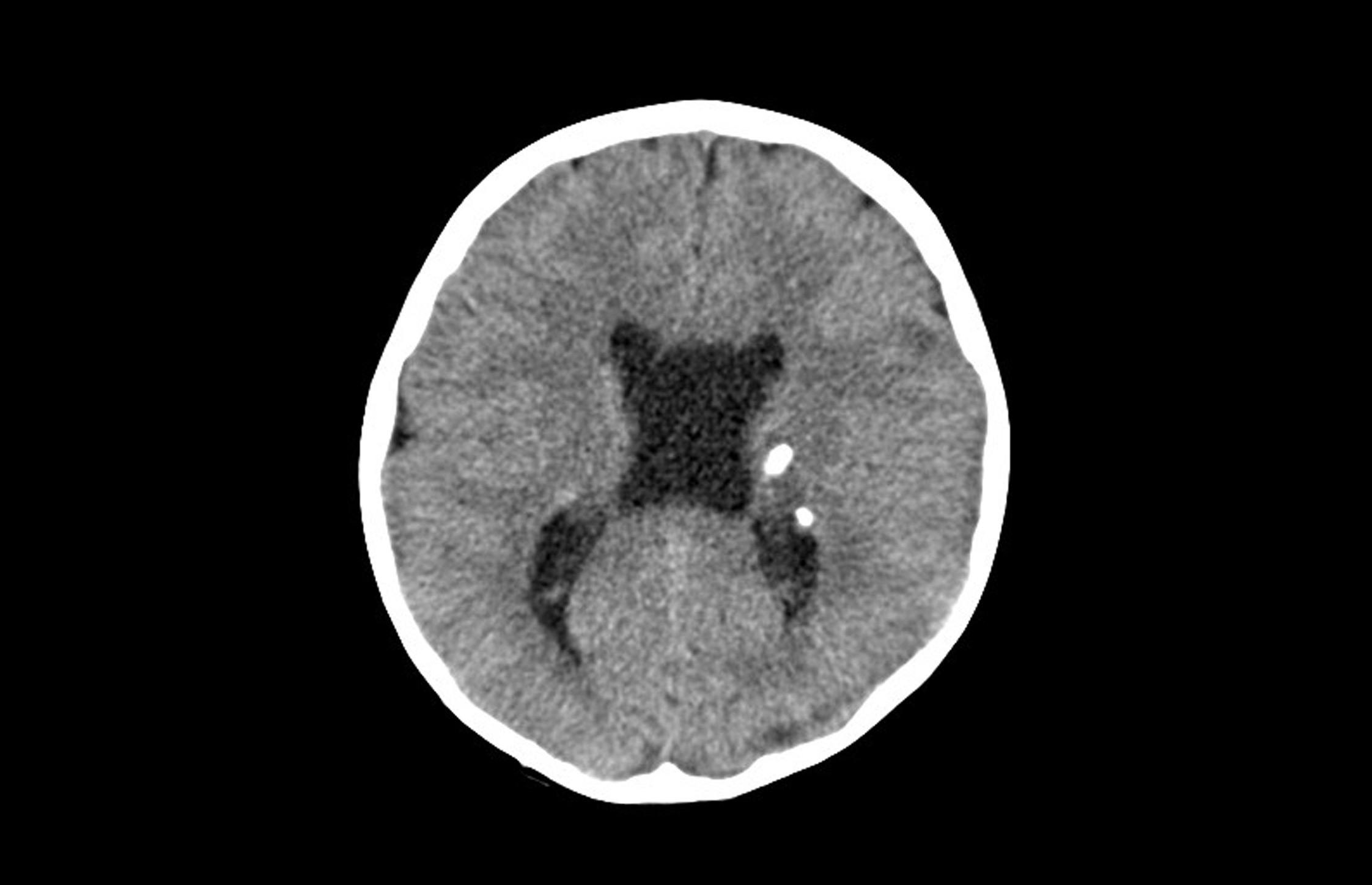 Figura 1. Placa alopécica inflamatoria con vesículas pustulosas en la zona parietotemporal derecha de 3 × 3 cm