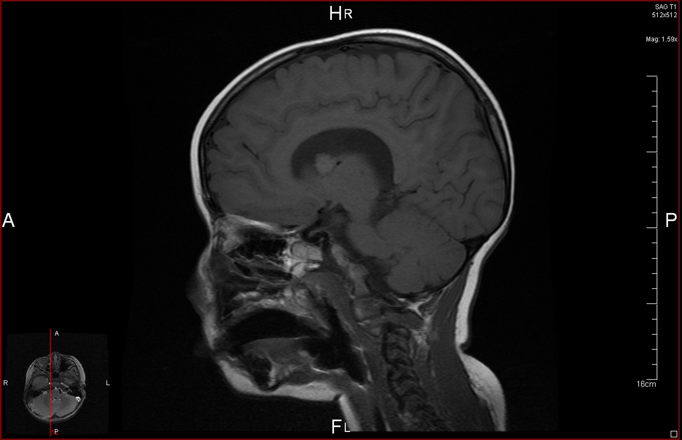 Figura 2. RM craneal: imagen nodular de 11 mm de diámetro cercana al agujero de Monro
