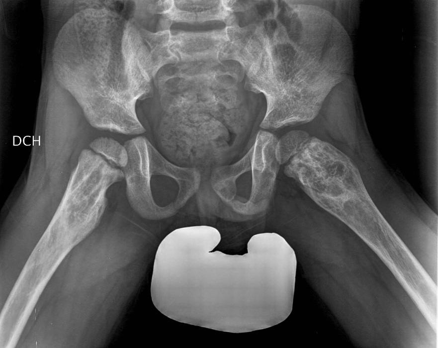 Radiografía de pelvis y miembros inferiores. Displasia fibrosa
