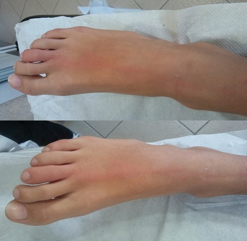 Edema_de_tercer_dedo_de_pie_derecho
