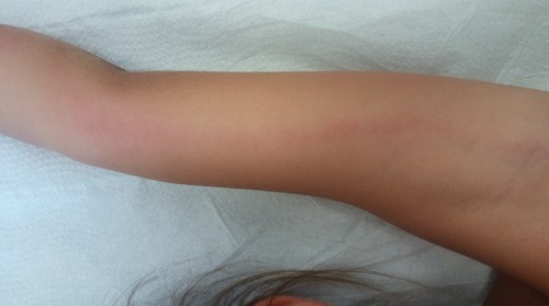 Trayecto_tubular_eritematoso