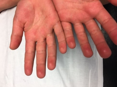 Pulpitis_en_las falanges_distales_de_ambas_manos