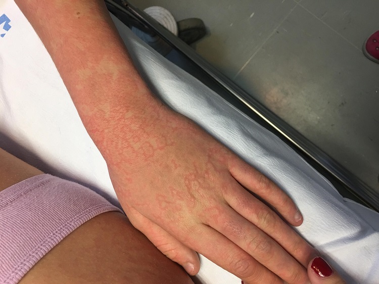 Exantema_reticular_por_parvovirus