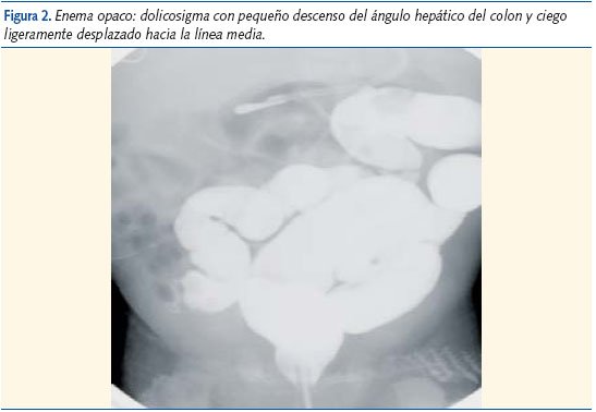 Figura 2. Enema opaco: dolicosigma con pequeño descenso del ángulo hepático del colon y ciego
ligeramente desplazado hacia la línea media.