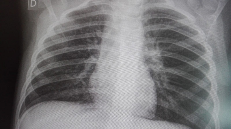 Radiografía anteroposterior