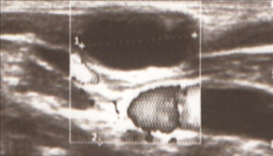 Ecografía en la que se observaron múltiples adenopatías
