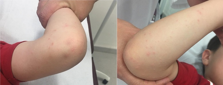 Lesiones micropapulares en codos y antebrazos