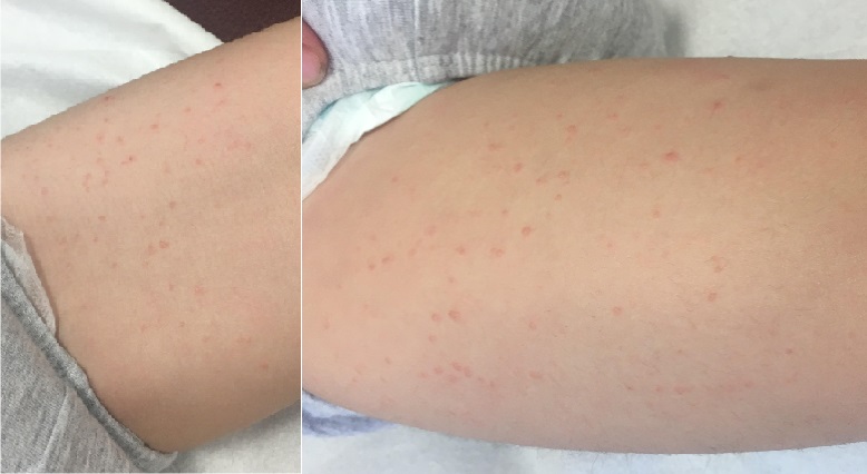 Lesiones micropapulares en ambos muslos