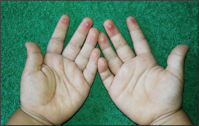 DPJP en niña de 34 meses