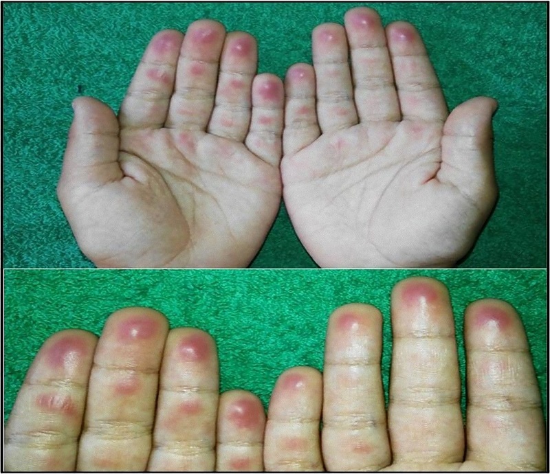 DPJP en niño de 6 años