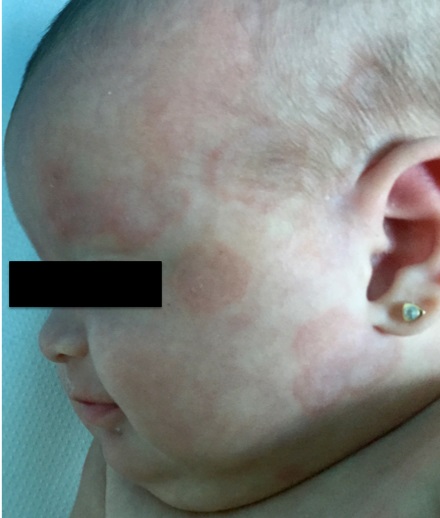 Lesiones_eritematosas_circulares_circinadas