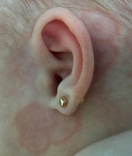 Lesiones_en_localización_retroauricular