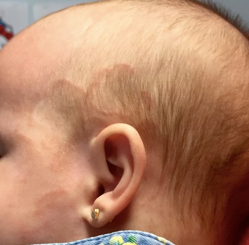 Lesiones_en_fase_de_resolución