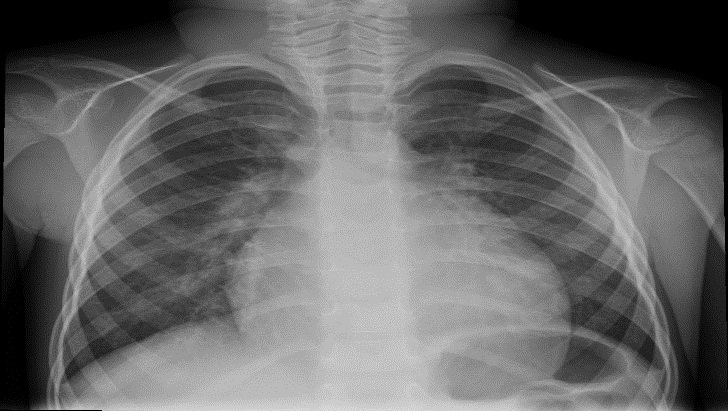 Radiografía posteroanterior de tórax