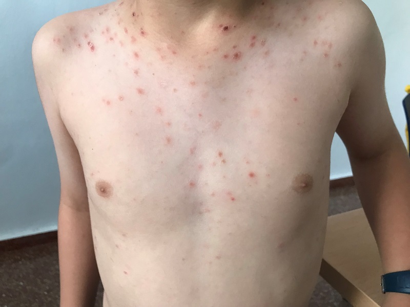 Erupción de elementos papulosos y papulonecróticos