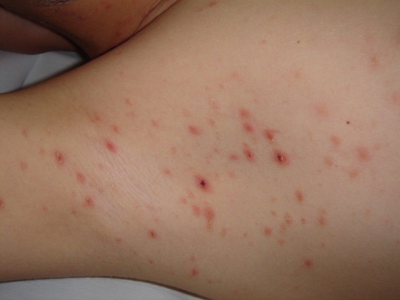 Erupción de elementos papulosos y papulonecróticos