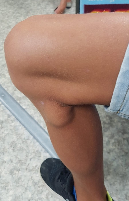 Adenopatía poplítea