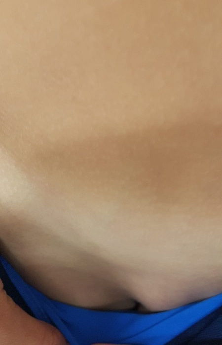 Adenopatía inguinal