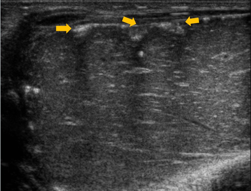 Imágenes hiperecogénicas subcapsulares hepáticas