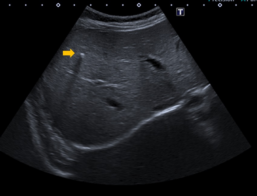Hiperecogenicidad intrahepática con sombra posterior