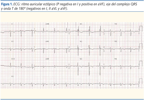 Figura 1. ECG: ritmo auricular ectópico (P negativa en I y positiva en aVF), eje del complejo QRS y onda T de 180º (negativos en I, II aVL y aVF).