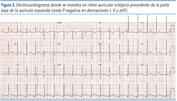 Figura 3. Electrocardiograma donde se muestra un ritmo auricular ectópico procedente de la parte
baja de la aurícula izquierda (onda P negativa en derivaciones I, II y aVF).