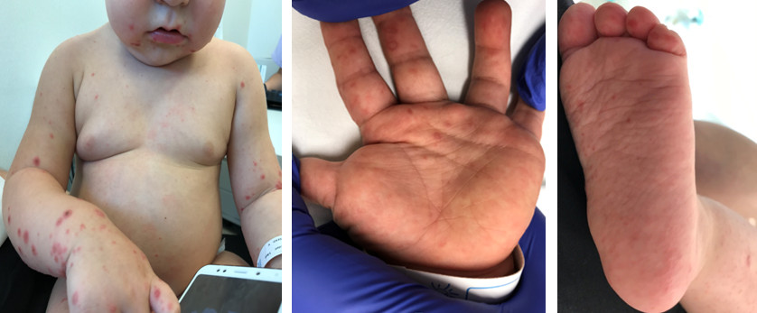 Lesiones máculo-pápulo-vesiculosas