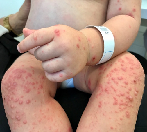 Lesiones pápulo-vesículo-ampollosas