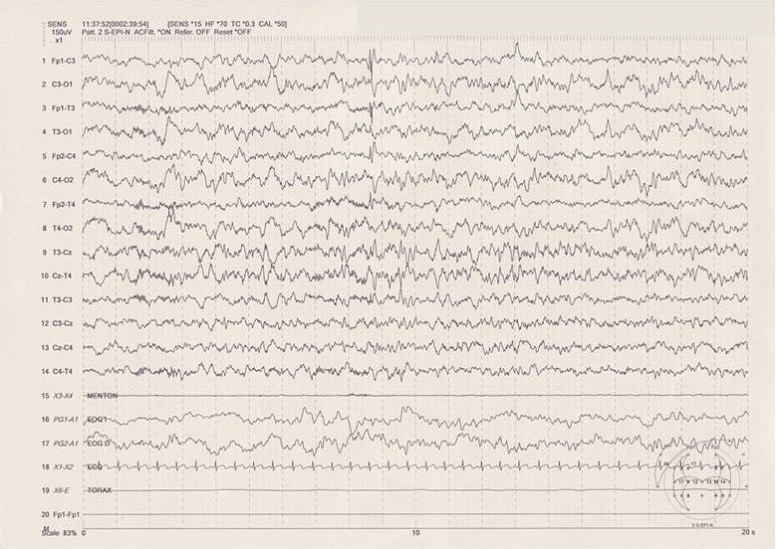 Figura 1. EEG de sueño diurno. Actividad punta onda aguda sobre regiones centrales en sueño nREM