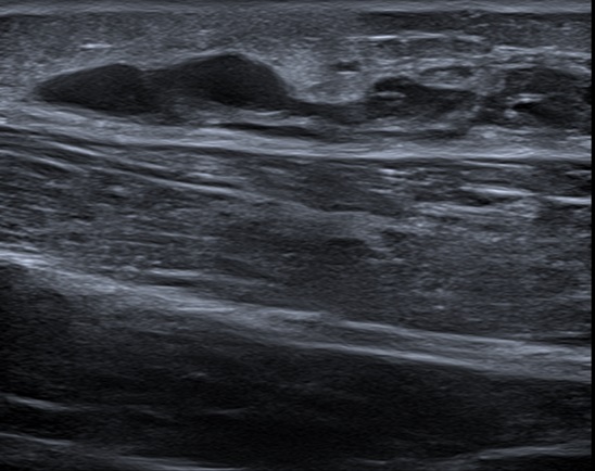 Figura 2. Ecografía de partes blandas. Región pretibial de la pierna izquierda donde se identifica una colección que mide 7 × 4 × 0,6 cm de diámetro, con varias loculaciones y ecos en su interior, localizada en la unión entre la fascia y el tejido celular subcutáneo