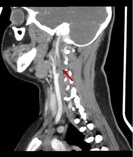 Figura 2. Imagen de TC (corte sagital) en la que se visualiza trombosis yugular interna izquierda (flecha)