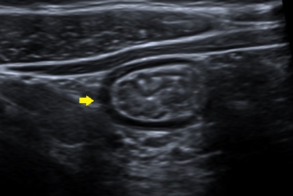 Ecografía abdominal. Se señala un asa intestinal de íleon terminal con un notable engrosamiento mucoso