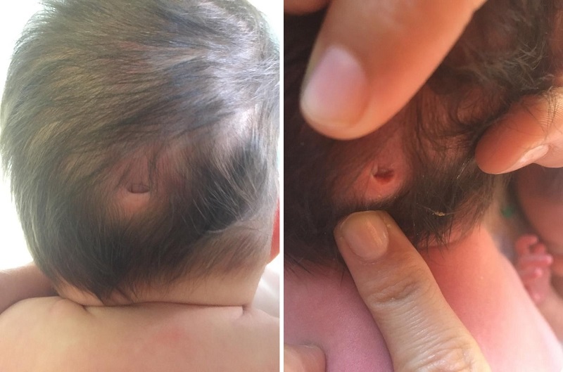 Figura 1. Hoyuelo cutáneo occipital, como hallazgo en la exploración física de la recién nacida