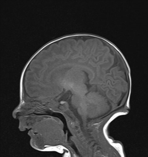 Figura 2. Trayecto del seno dérmico subcutáneo en resonancia magnética craneal (secuencia T1 sin contraste intravenoso)