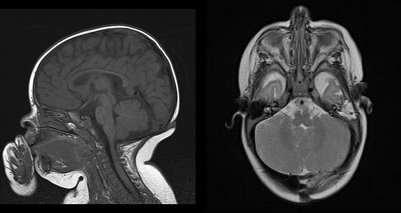 Figura 3. Trayecto del seno dérmico subcutáneo en resonancia magnética craneal de control (secuencia T1 sin contraste intravenoso)