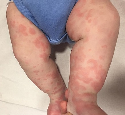 Figura 1. Morfología anular y policíclica de las lesiones.