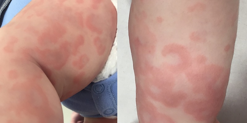 Figura 2. Lesiones habonosas de centro violáceo.