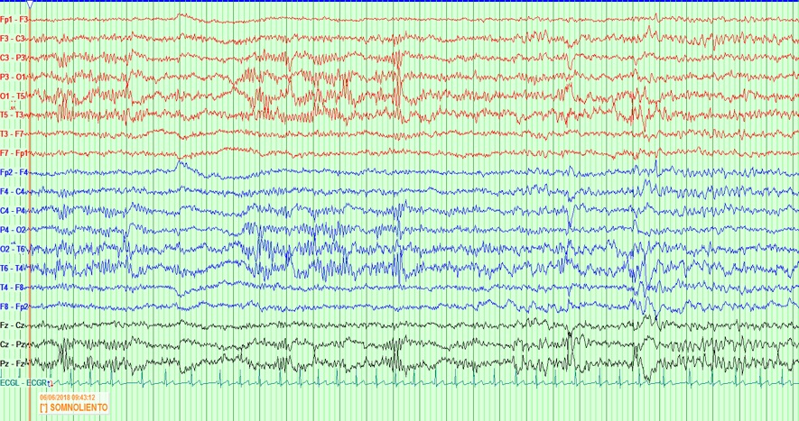 Electroencefalograma con actividad punta-onda 4-6 Hz bilateral de inicio en región temporal derecha